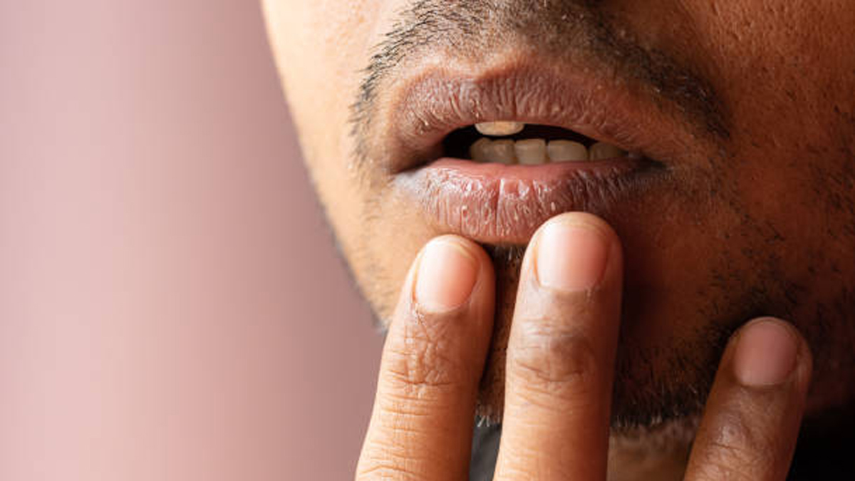 Cara Mengatasi Bibir Pecah-Pecah Saat Puasa: Tips Ampuh Agar Tetap Lembap dan Sehat