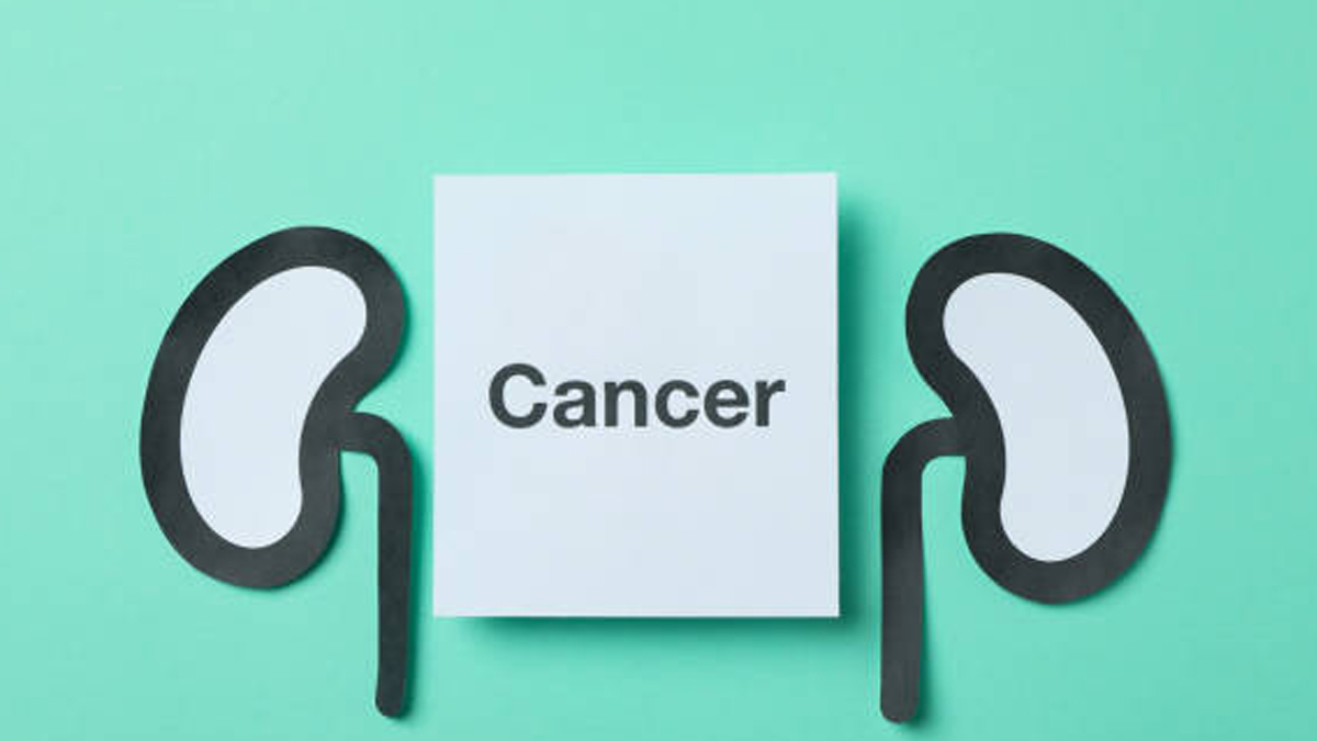 Bahaya Kanker Ginjal yang Sering Tak Disadari: Gejala, Pencegahan, dan Terapi