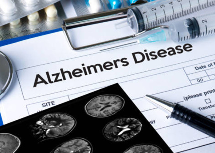 Apakah Alzheimer Bisa Disembuhkan? Ini Penjelasan Medis dan Pilihan Obatnya