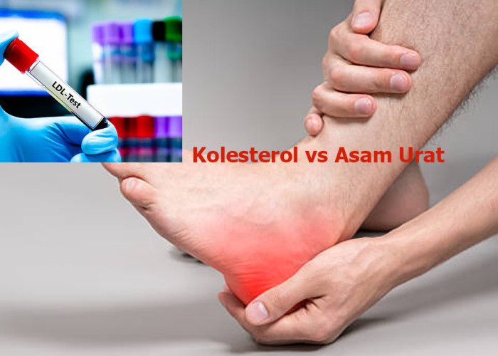 Kolesterol Tinggi dan Asam Urat Sering Muncul Bersamaan, Mana yang Harus Diobati?