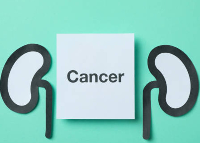 Bahaya Kanker Ginjal yang Sering Tak Disadari: Gejala, Pencegahan, dan Terapi